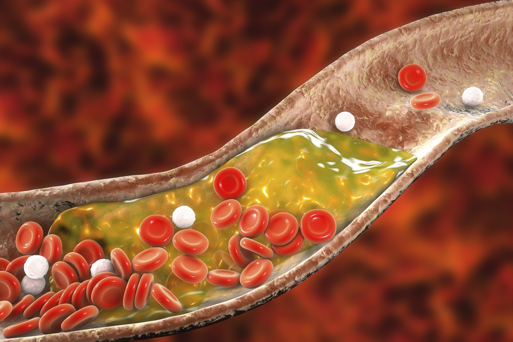 Vaisseaux sanguins : pathologies et soins